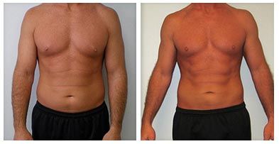 HIFU vs Botulinum Toxin: Understanding the Differences 3 man tones