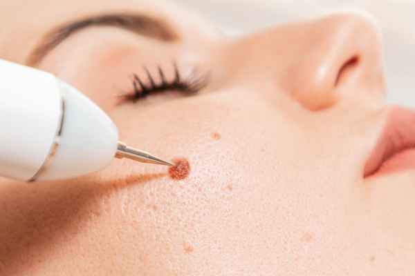 CryoPen: 5 Skin Concerns It May Be Used to Treat 3 What actually happens during a CryoPen treatment Scotland?