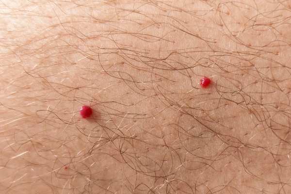 CryoPen: 5 Skin Concerns It May Be Used to Treat 2 cherry angioma removal Scotland