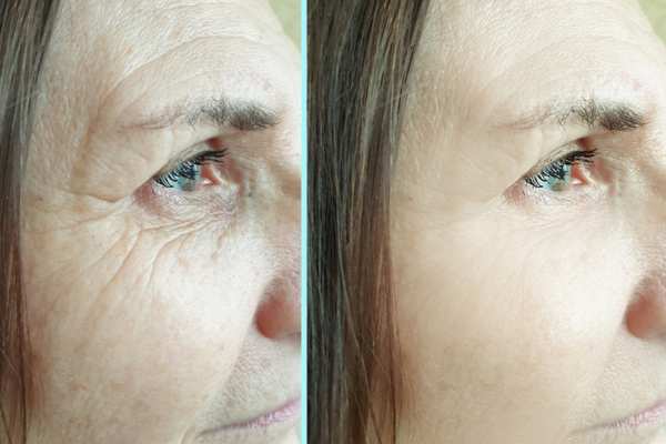 Why Do People Choose HIFU for a Non-Surgical Facelift? 4 How long can HIFU results last Scotland?