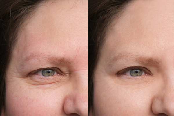 HIFU vs Botulinum Toxin: Understanding the Differences 4 How long do HIFU results last Scotland?