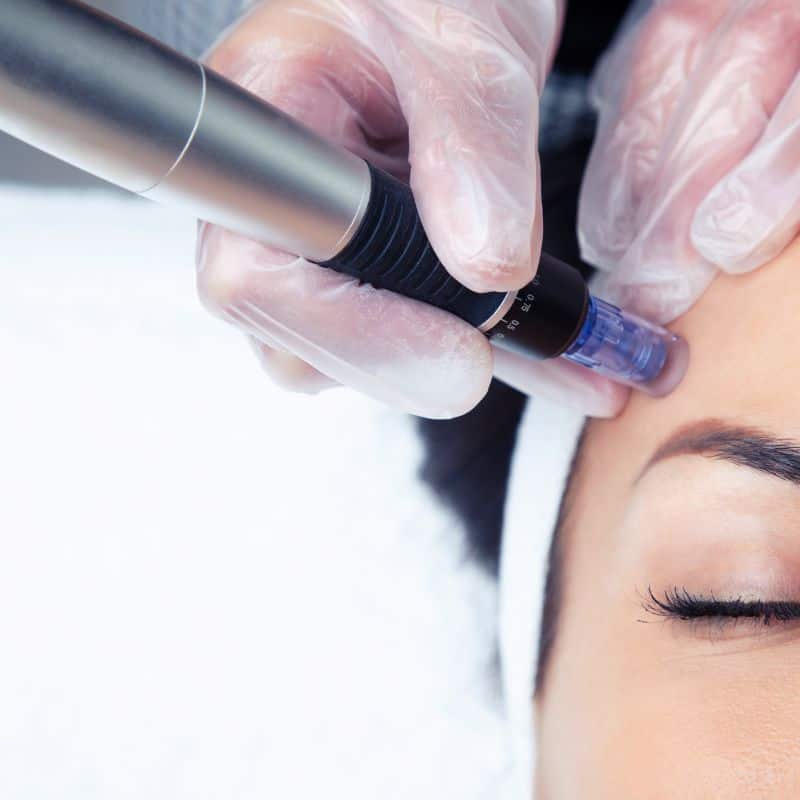Morpheus8 treatment Scotland from Lipo Sculpt - Book in today!